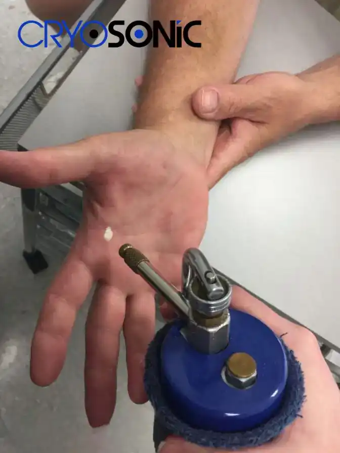 Temperature Differences: OTC vs Medical-Grade Cryotherapy Deal